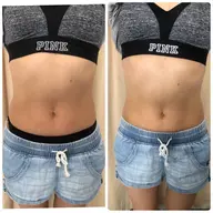 【10月平日限定クーポン🌴】お腹周りのお肉撃退!セルライト除去。