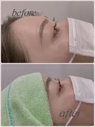 フェイシャルシェービング(お顔剃り)