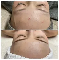 【小顔×肌質改善】赤み・剥離なしの国産ハーブピーリングプログラム&小顔矯正