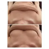 ミラクルウェーブ（バストアップ）＋コラーゲンマシン40分