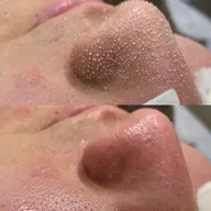 【毛穴汚れ・黒ずみが気になる方】ハイドラ毛穴洗浄🫧