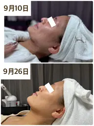 超音波エステ+肌質悩み別パック4週間分スキンケアセット付き✨