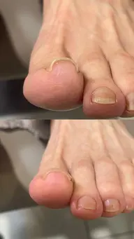 【巻き爪ケア】１本