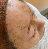 本気の毛穴悩みに向き合える肌になれる💖毛穴徹底洗浄×肌質ケアハーブ（剥離なし）／ツヤ肌へ💎