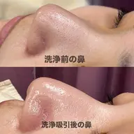 【🧼毛穴洗浄】顔剃り+小鼻洗浄+拭き取りパック✨