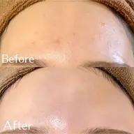 【最新の韓国式】お肌のお悩み🌿ハーブピーリング