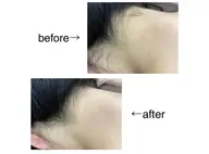 【レディース】ブライダルにオススメ◎背中全体+うなじ脱毛¥5,300→¥3,500