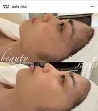 【当店が初めての方限定】保湿フェイスマッサージ+毛穴クレンジング🪠🤍まずは小顔ケアを体感したい方✨✨