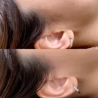 お顔のくすみ、産毛が気になる方募集⭐︎フェイシャルWax脱毛でお顔がツルツルに。