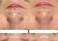 🌟平日限定¥3,300🌟ハイドラ毛穴洗浄🫧