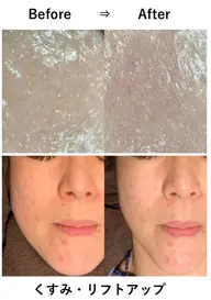 DTなし👋🏻‪新世代ピーリング"バイオピール®"どんな肌質の方でも施術可能💆🏻‍♀️✨顔脱毛付きコース🤍