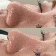 【ハイドロフェイシャル 毛穴洗浄️🩵】毛穴ケア/くすみ/肌質改善