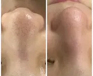 【毛穴洗浄🍓✨】ニキビ/美白パック付き✨