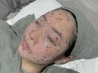 フルフェイスWAX顔脱毛×鼻のみ毛穴洗浄