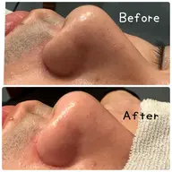 毛穴エクストラクション