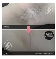 ワキ脱毛✖️3回