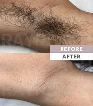 ［仙台　メンズ脱毛］　メンズワキ脱毛