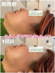 【リンパ/小顔】⭐️ウルトラプラス３Dリフトアップ＋首リンパ付き⭐️￥24800⇒￥14800