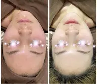 ハーブピーリング(剥離なし)