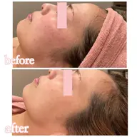 ✨人気No.1✨お顔の脱毛ならお任せください✨毛＆毛穴の両方にWの効果で毛穴レス肌🫧IPL照射で効果絶大の声多数！
