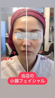 スプリングキャンペーン🌸一番人気！小顔リフトアップオールハンドフェイシャル