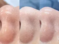 【毛穴洗浄】ハイドロディープクレンジング/小鼻の黒ずみ集中ケア