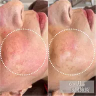 【肌荒れ•ゆらぎ肌に】艶肌ジュエリーピール＋毛穴洗浄で肌荒れケア　ヘッドスパ＆首肩デコルテトリートメント付き