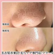 毛穴の汚れを根こそぎ洗浄＋フェイシャル＆デコルテマッサージ