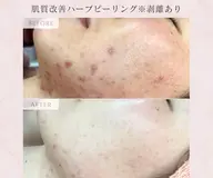 【ミニモ限定価格❤️‍🔥】【結果で選ばれる】肌質改善ハーブピーリング（顔)※剥離あり¥22,000→¥13,000