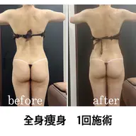 【男女/新規/ボディラインが気になる薄着の季節前に】筋膜リリース全身痩身90分¥18000→¥11000
