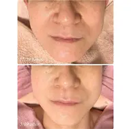 究極のリフトアップ3回コース❣️❣️FACE MAKE 4Dクリーム1本プレゼント🎁