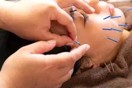 初回限定！琉球美ら鍼　通常16000円→10000円