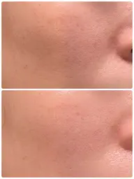 【皮膚の緩み｜張り｜たるみ】リフトアップフェイシャル※おひとり様1回のみ