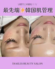 💎ダイヤモンドピール💎渡韓不要水光肌に🫧⏰60分