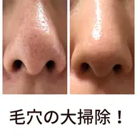 【毛穴で悩んだらこれ！】毛穴すっきりスタンダードコース