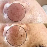 ❤️ミニモ限定特別価格❤️毛穴の黒ずみ角栓徹底除去！！エクストラクション【鼻or顎】集中ケア✖️Tゾーンワックス脱毛付き