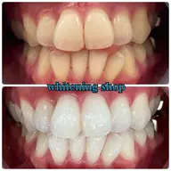 《垢抜けセット✨️》たっぷり40分照射美白セルフホワイトニング＋耳つぼジュエリー