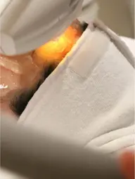 【小顔矯正】顔全体 別人級・切らないリフトアップ!短期間で憧れのVライン形成♪