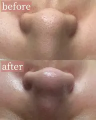 【毛穴エクストラクション】鼻の黒ずみ・ざらつき・いちご鼻に♡