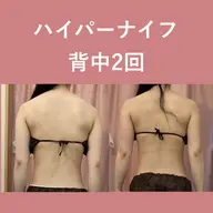 【選べる上半身or下半身45分】脂肪を燃やす!ハイパーナイフ痩身