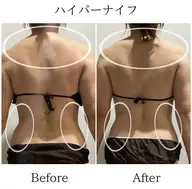 背中痩せ🔥ハミ肉撃退👊誰もが羨む背中美人へ✨¥25,300→¥6,600