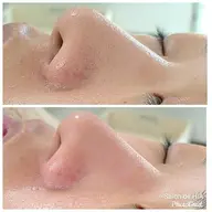 45分🕑️【毛穴】New!!✨毛穴エクストラクション👃毛穴レストリートメント