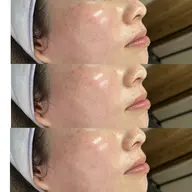 フェイシャルワックス脱毛