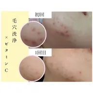 【黒毛穴×ニキビケア】大人気！全顔毛穴洗浄+スーパービタミンC微弱電流導入+ミニモ限定高保湿クリーム¥5500