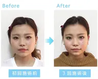 歪み・エラ・むくみ・小顔矯正（整顔）ベーシック 45分
