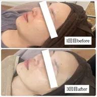 ハーブピーリング【しみ、シワ、たるみ】