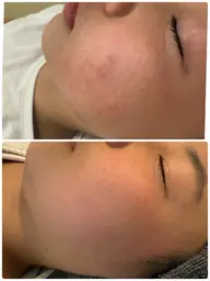 【剥けないハーブピーリング】ダウンタイム無いです