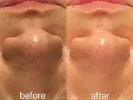 【ミニモ限定】 🌱毛穴レス/赤み/ニキビケア🌱艶肌+毒素デトックス　ハーブピーリング　60分