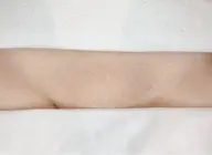 【VIO-W脱毛】ワックス脱毛後に光脱毛