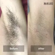 【メンズ】ワキ脱毛 ♪保湿ケア付♪